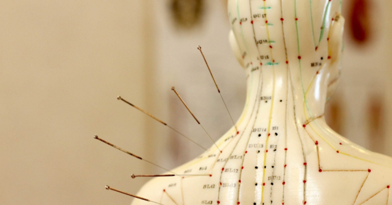 Traditional Chinese Medicine (TCM) Acupuncture in Singapore: A Holistic Approach to Wellness