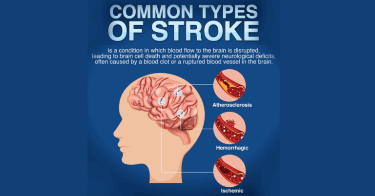 TMS for Stroke: A Breakthrough in Post-Stroke Recovery
